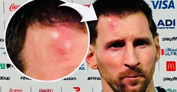 Messi sưng vêu trán sau trận thắng Cabo Verde: Vì sao nên nỗi? - hình ảnh - winjun88.com Messi sưng vêu trán sau trận thắng Cabo Verde: Vì sao nên nỗi? - hình ảnh - winjun88.com